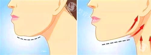 拉皮手术示意图