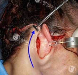 拉皮手术切口图