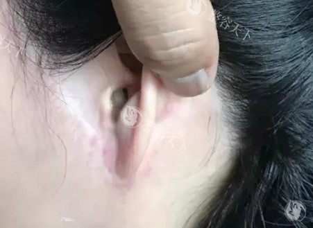 拉皮手术疤痕图