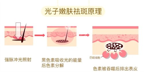 光子嫩肤的祛斑原理