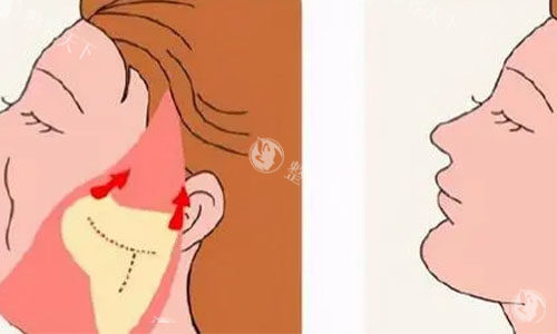 拉皮手术的术后对比图