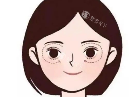 眼角下垂示意图