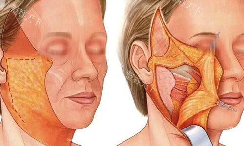 拉皮手术过程动画示意图