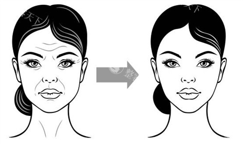 面部提升手术改善面部皱纹