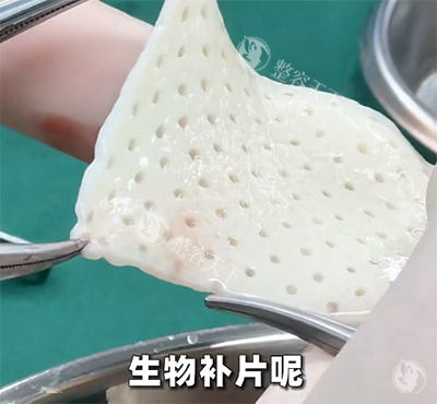 生物补片增粗为什么选聂明医生？3大核心技术优势拆解