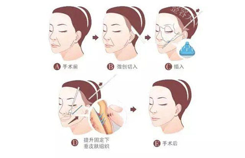 安多泰拉皮手术