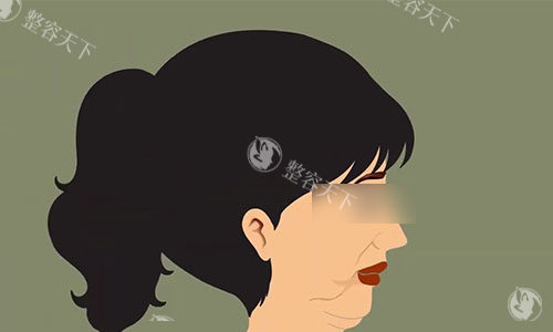 拉皮手术前的动画示意图