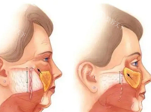 面部筋膜层拉皮提升卡通示意图