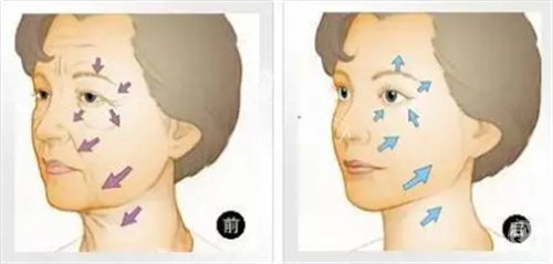 面部抗衰对比图