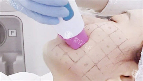 面部热玛吉治疗