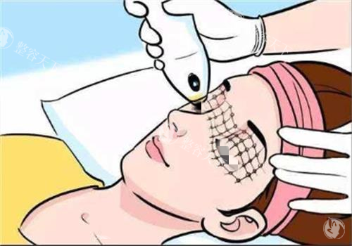 光子嫩肤过程图