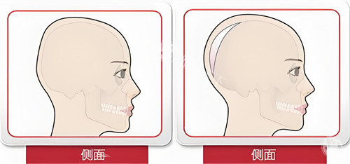 头部填充侧面对比动画图