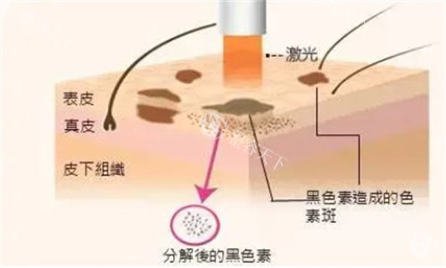 激光祛斑手术原理图