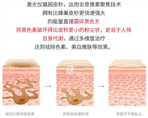 激光祛斑前后的对比