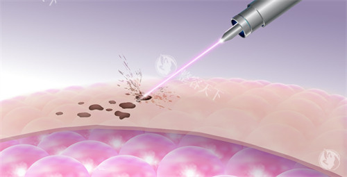 激光改善皮肤斑点