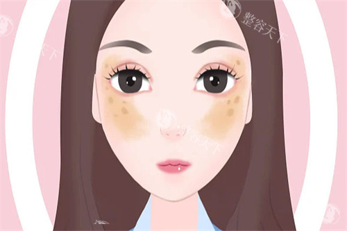 黄褐斑图片一览