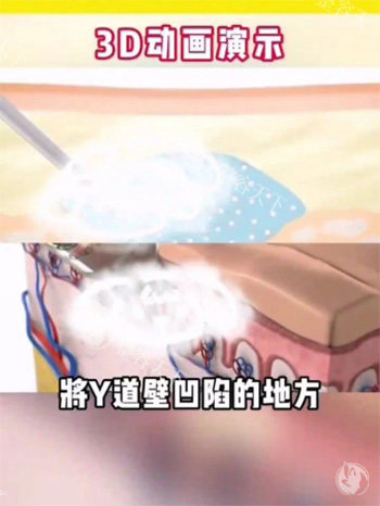 紧缩针注射阴道动画图