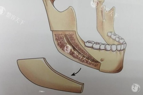 下颌角截骨卡通图