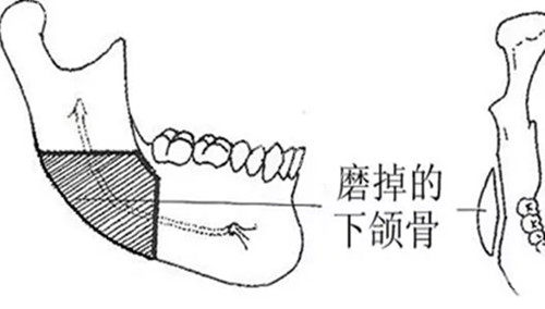 下颌外板位置示意图