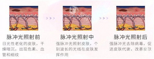 光子嫩肤对比