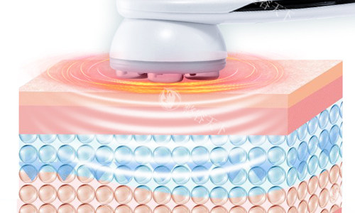 光子嫩肤激光展示