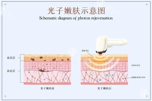 光子嫩肤的示意图