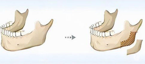 下颌骨劈外板卡通示意图