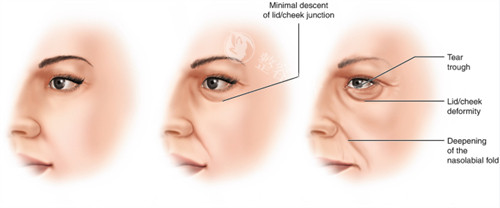 面部提升改善不同程度的面部老化