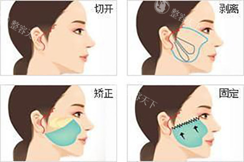面部耳际小切口拉皮示意图
