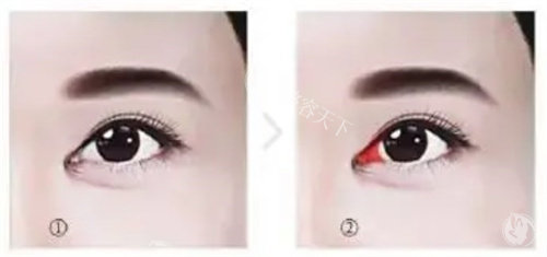 眼部整形在线询问！24小时解答双眼皮/开眼角/眼修复等项目