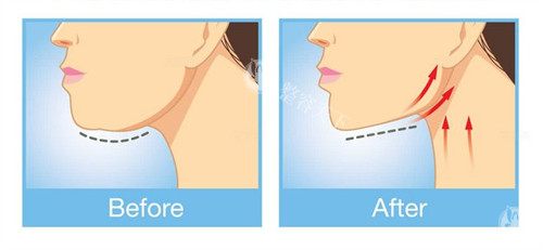 下巴提升紧致整形前后对比图