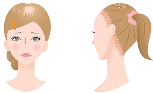 女生脱发类型