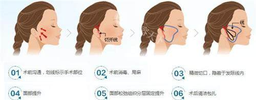 微拉美拉皮手术过程图