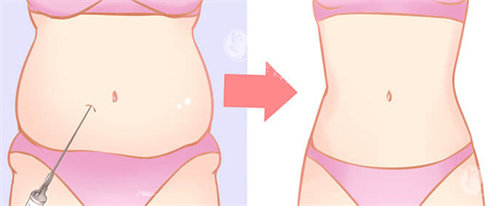 赵军舰抽脂贵吗？价格大公开！面部吸脂12800元起，腰腹环吸16800元起，全身吸脂2万元起