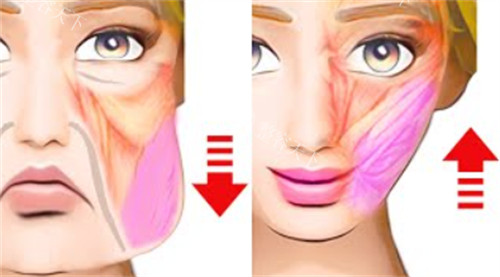 从忐忑到惊喜：一位素人在上海杨胤恒医生处体验筋膜提升术的完整心路历程