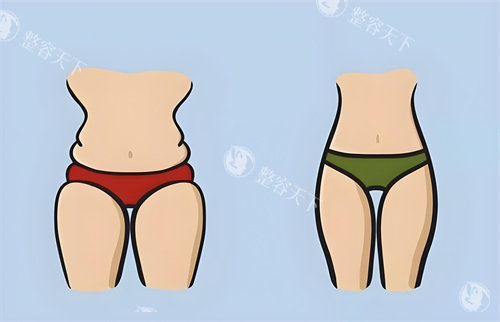 技术大PK：人鱼体雕和普通吸脂区别解析，教你如何按需选择