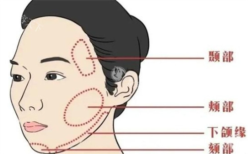 深度剖析童颜微提与筋膜提升的差异：如何选对适合自己的抗衰术？