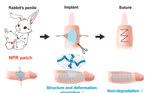 阴茎生物补片演示过程
