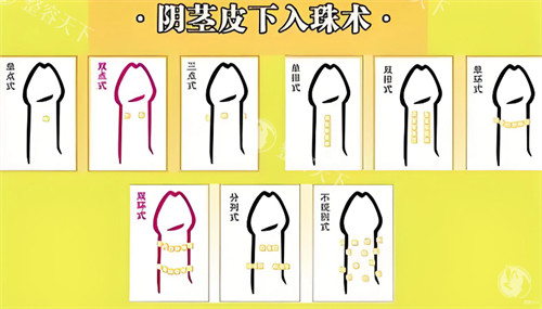 阴茎皮下入珠术