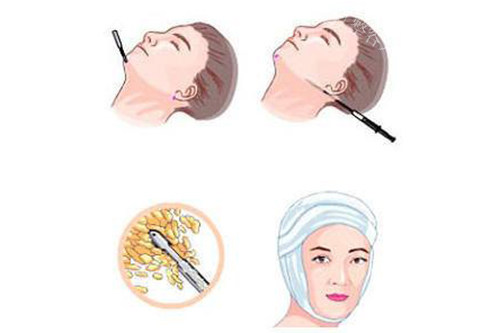 面部吸脂后会出现皮肤松弛吗？宁波壹加壹医生采用内缝合技术，从根源解决皮肤松弛并隐藏疤痕