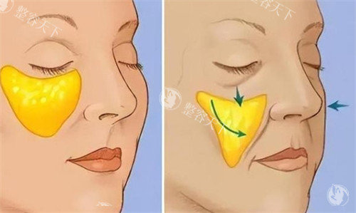 郭玉瑞小切口拉皮有失败实例吗？分层提升+筋膜复位+抗衰结果持久！