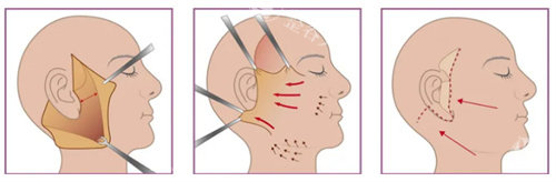 袁强MCR与谢宏彬大拉皮区别在哪？前者主打SMAS多矢量提升，后者以深层折叠祛皮见长