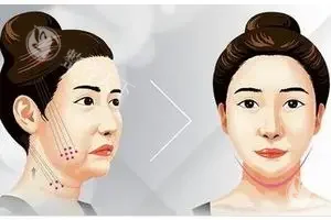 骨韧双修术整容多少钱？价格从6800元起！骨相重塑+韧带提升+分层抗衰+自然塑形！
