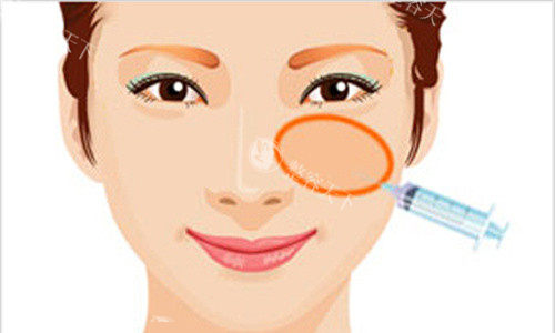 面部苹果肌填充图