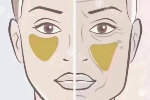 苹果肌下垂卡通对比图