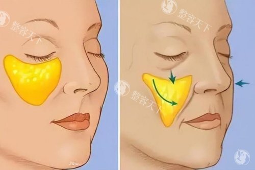 苹果肌下垂于正常苹果肌卡通对比图