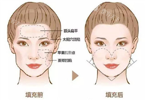 自体脂肪填充前后对比图