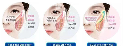 三类拉皮手术方法对比