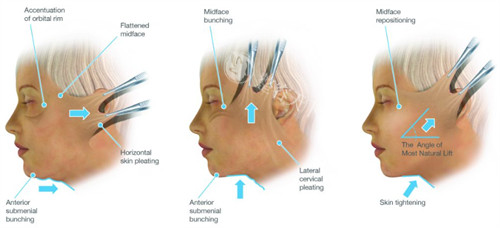 拉皮手术不同角度