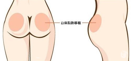 自体脂肪丰臀